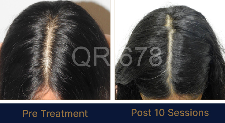 QR678NEO Therapy for Hair Loss